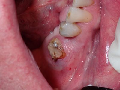 NSankhyan - 45 and 46 (immediate) implants