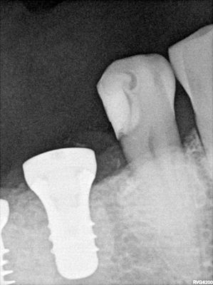 NSankhyan - 45 and 46 (immediate) implants