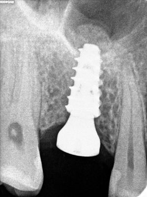 ATam - 16 - sinus lift