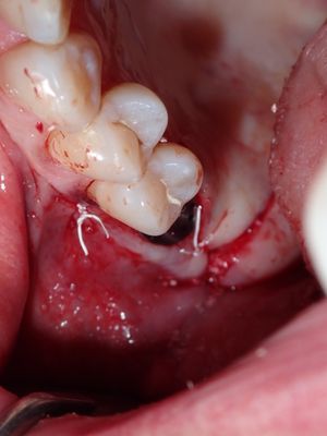 Mkim - 16 implant redo
