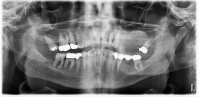MWang - Left sinus augmentation