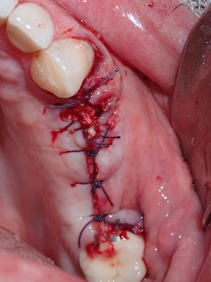 MWang - Left sinus augmentation