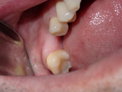 ATam - implant 36
