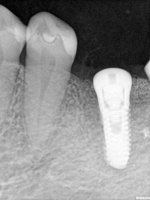 ATam - implant 36