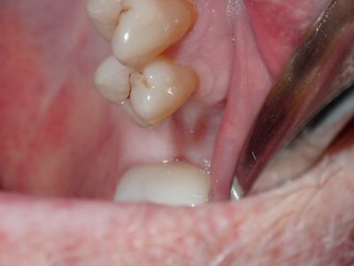 NSankhyan - 26 sinus lift