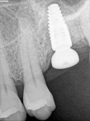 NSankhyan - 26 sinus lift