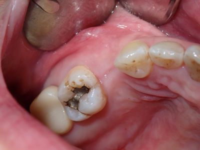 MKim - 15 implant 