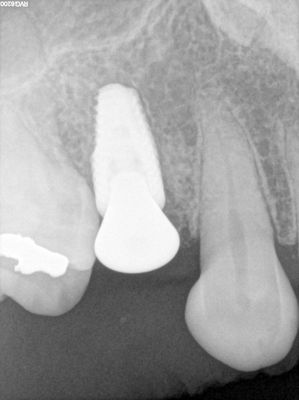 MKim - 15 implant