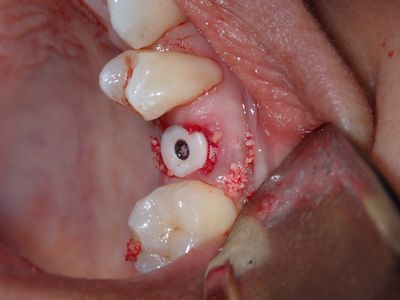 WYu - 24 implant