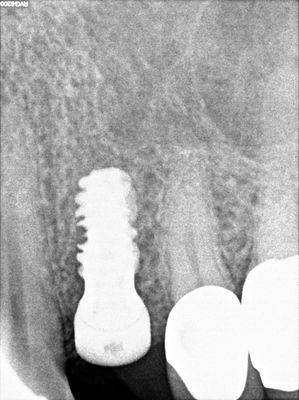 WYu - 24 implant
