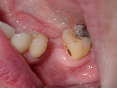 WYu - 35 implant 
