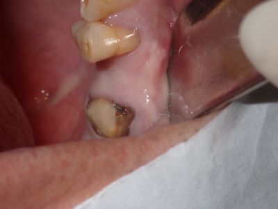 Wyu - 25 implant 