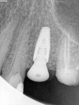 Wyu - 25 implant