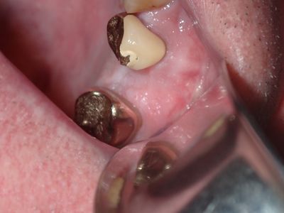 WYu  - 25 implant buccal tori