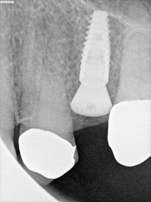 WYu - 25 implant buccal tori
