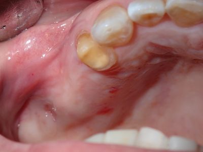 JLin - 15 16 implants