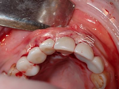 NSankhyan - 12 implant bone graft