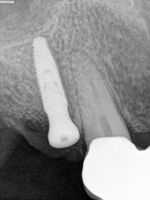 Mtiu - implant with bone expansion and graft