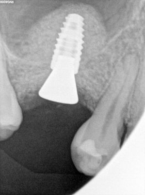 MWang - 15 internal sinus lifting - post failed sinus augmentation