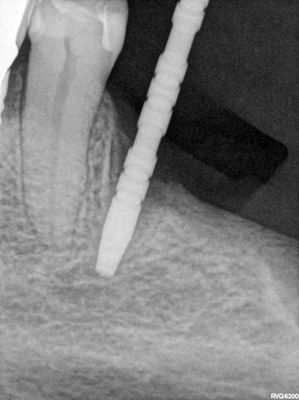 JGolos - llq implants