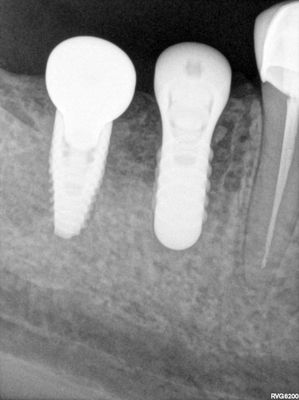 JLin - 46 47 implants