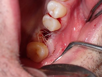 PWong - remove impl 26 and graft