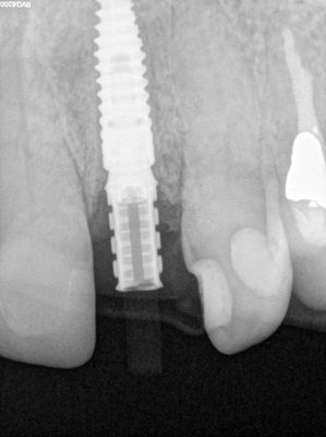 NSankhyan - immediate load 22