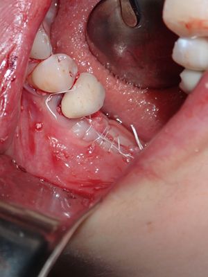 TZeng - vertical bone graft