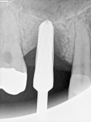MKim - 16 - int sinus lift --> sinus aug