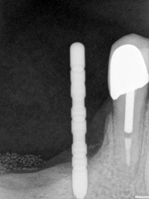 JGolos - llq implants