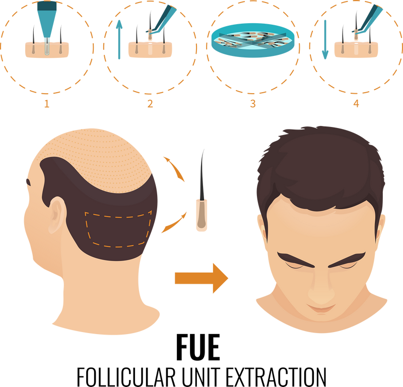 FUE Hair transplant surgery in London, UK.