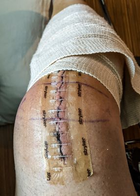 Thats going to leave a mark! Recovering from my knee replacement surgery