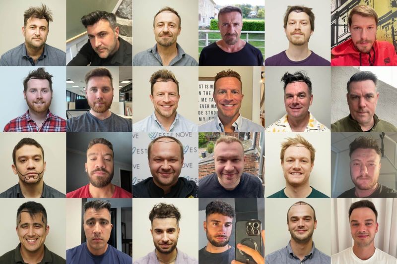 Real Talk: What Its Like to Get a Hair Transplant in Turkey