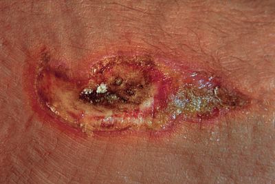 ELECTRICAL BURN / Brlure lectrique