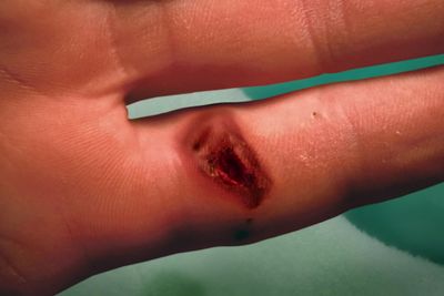 ELECTRICAL BURN / Brlure lectrique