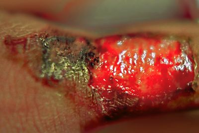 ELECTRICAL BURN / Brlure lectrique