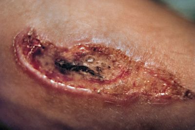 ELECTRICAL BURN / Brlure lectrique