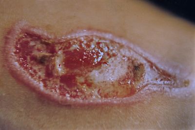 ELECTRICAL BURN / Brlure lectrique