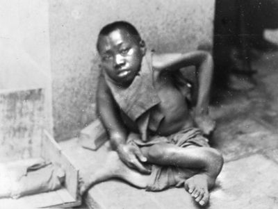 Deformed street beggar