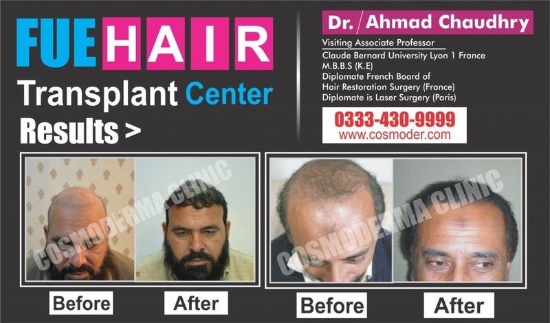 Questions to ask after Hiring Best FUE Hair Transplant Doctor in Pakistan