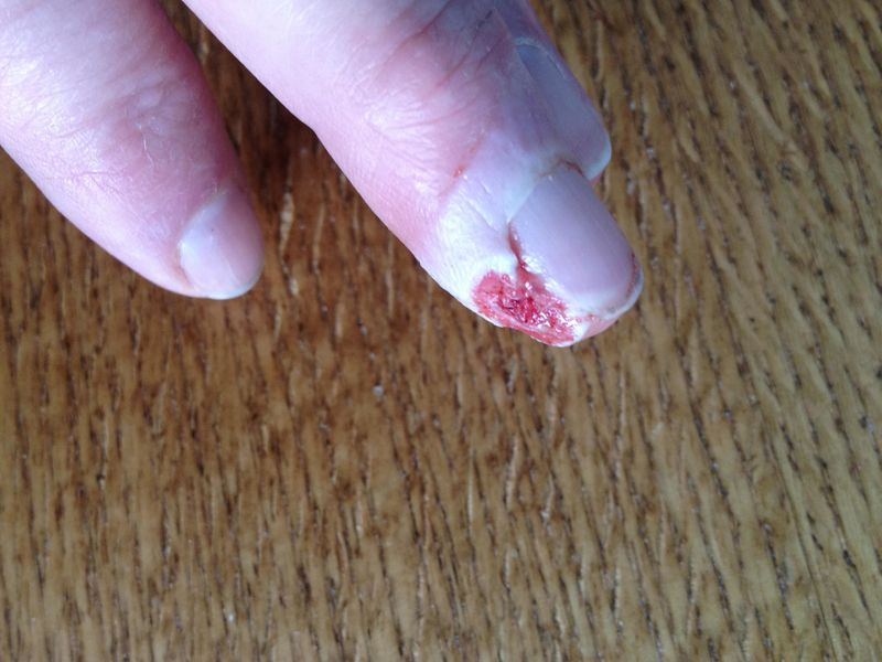 Tablesaw/Finger interference... the tablesaw won!