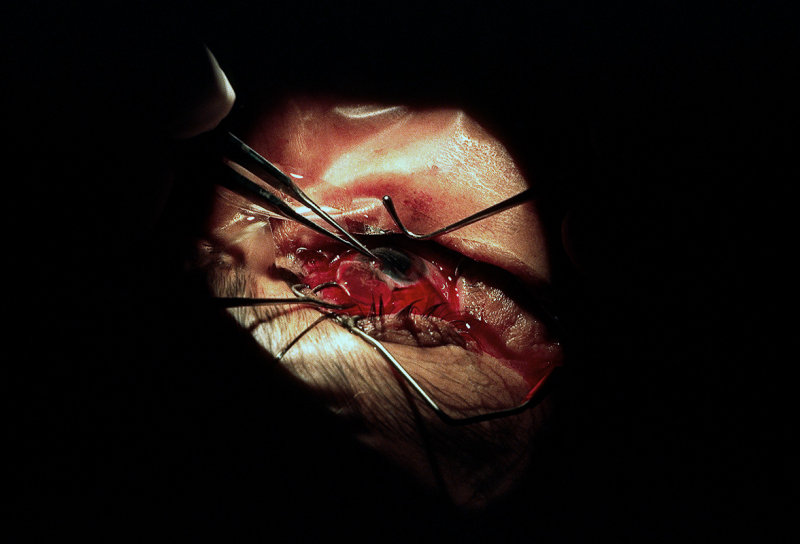 Cataract Surgery