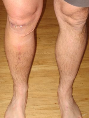 ACL 006.jpg