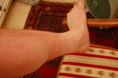 My sunburned leg after 3 days of wandering around outside under the blazing sun in heat that ranged from the 90s to over 100 F.