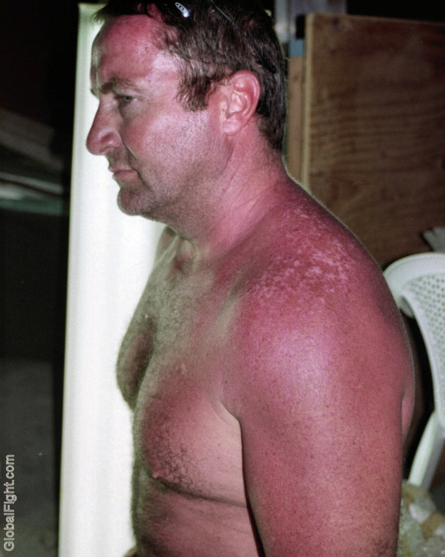 carolina jim sunburned arms shoulders.jpg