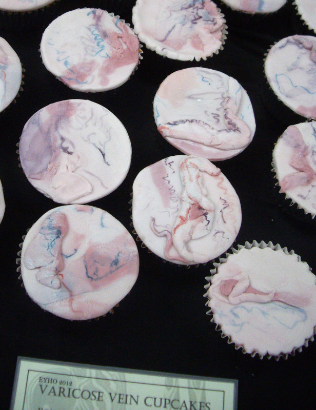 Varicose veins cup cakes