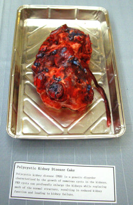 Polycystic kidney