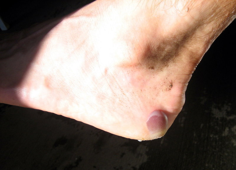 blood blister