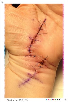 27/2 Stitches out today