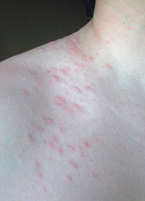 Orgyia_induced_urticaria.jpg